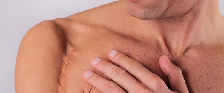 Littekens - Kan Skin Clinic Bussum