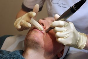 Microneedling