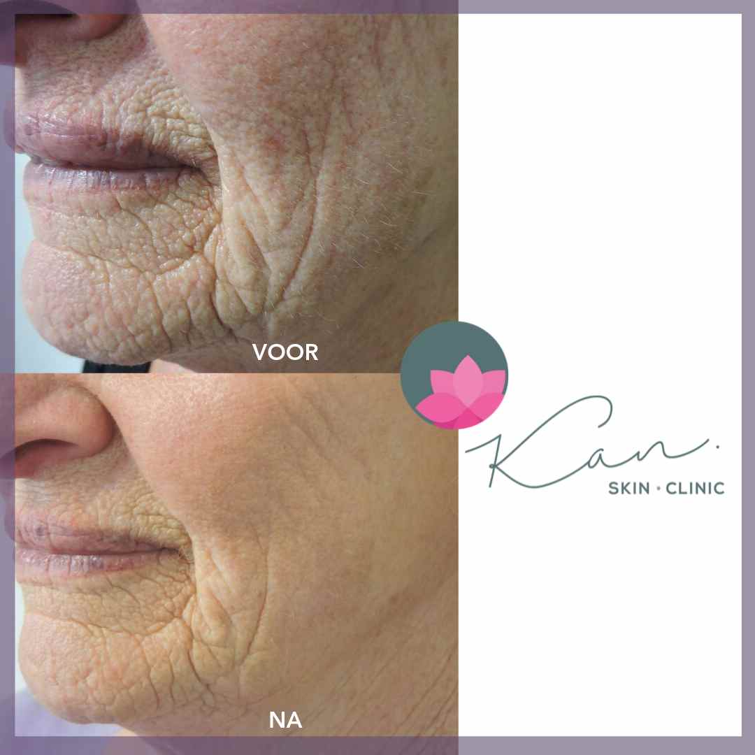 Huidveroudering - voor - na