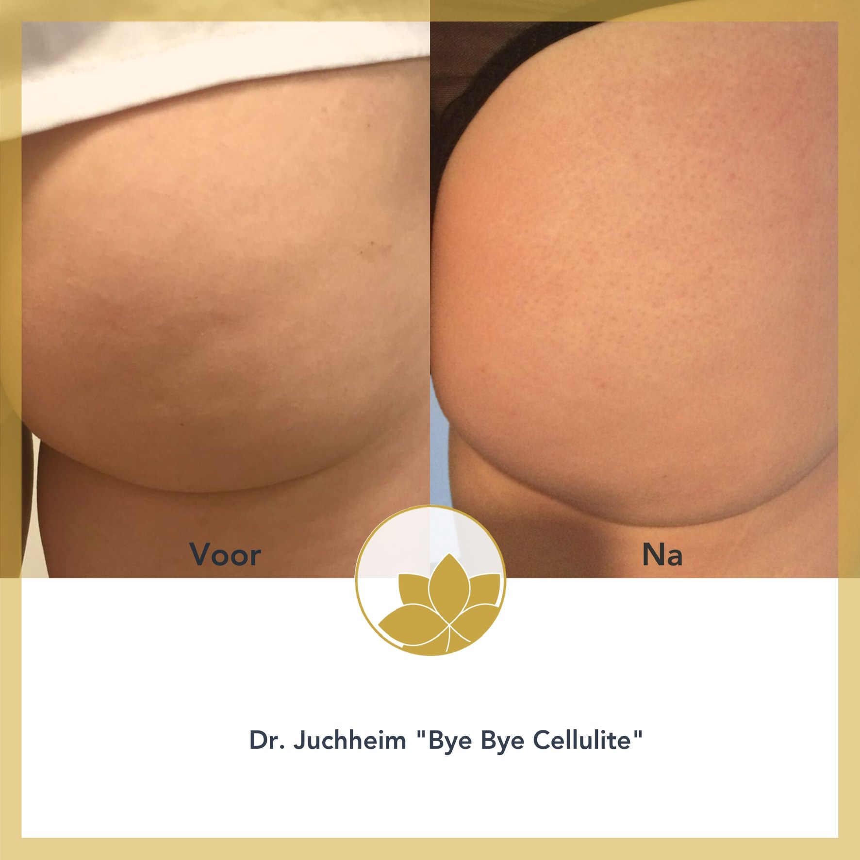 Dr Juchheim Bye bye cellulite