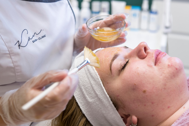 Huidtherapie - Acne - Chemische peeling