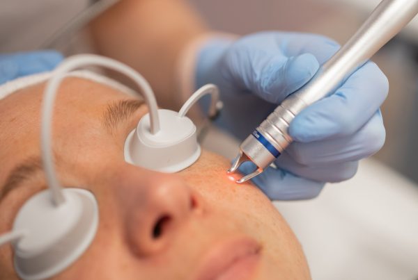 Coaguleren - Kan Skin Clinic Bussum - Coagulatie