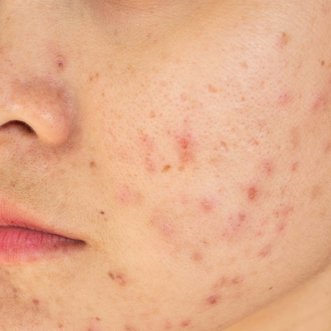 Veel voorkomende huidproblemen - acne