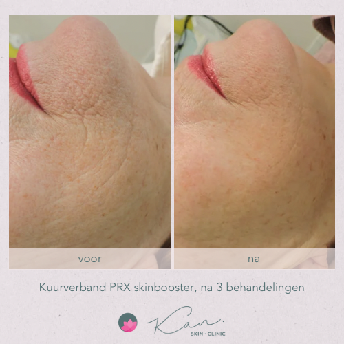 PRX Skinbooster Kuur huidverjonging