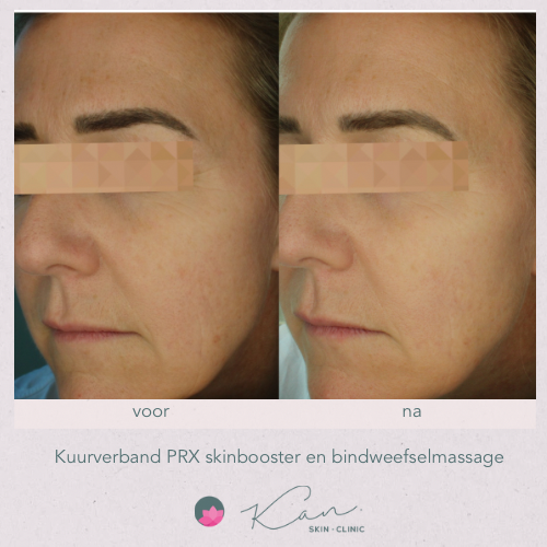 PRX Skinbooster + bindweefselmassage