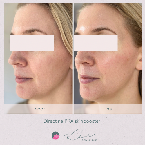 Skinbooster PRX