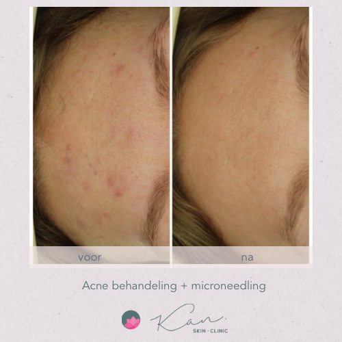 acnebehandeling en microneedling