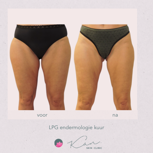 LPG Endermologie kuur