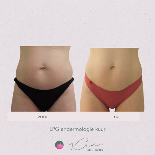 LPG Endermologie kuur, buik