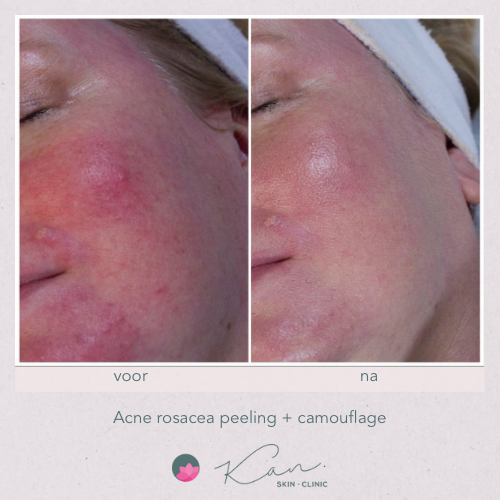 Acne Rosacea peeling en Camouflage