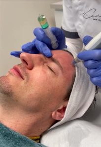 Microneedling