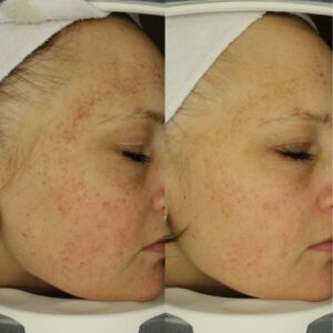 Multiskin Huidanalyse