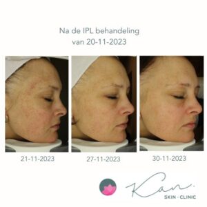 Reclear IPL