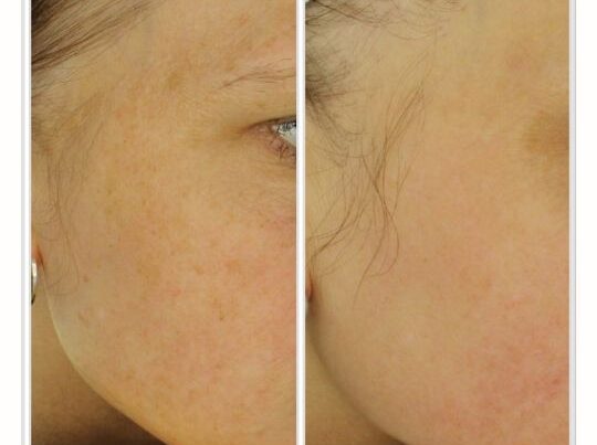 Reclear IPL