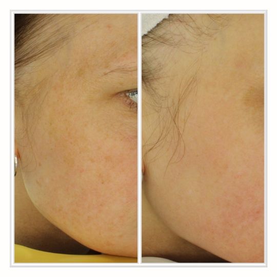 Reclear IPL