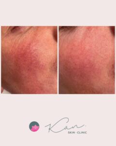 Reclear IPL