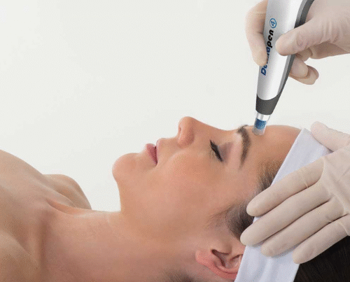 Microneedling met de Dermapen Kan Skin Clinic Bussum