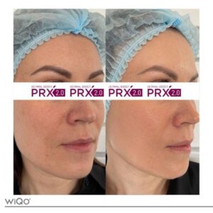 PRX-T33 Skinbooster - Kan Skin Clinic Bussum