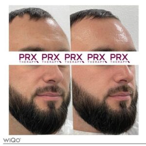 PRX-T33 Skinbooster - Kan Skin Clinic Bussum