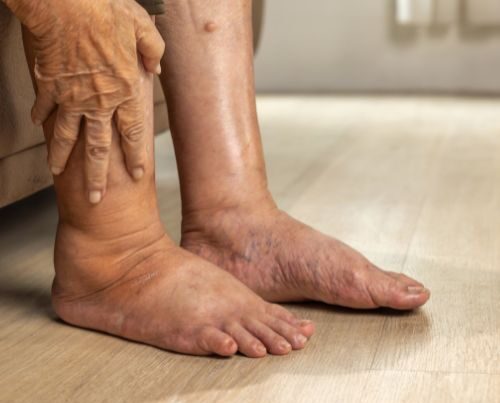 Lymfoedeem - Oedeem - Kan Skin Clinic Bussum