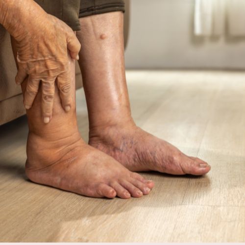 Lymfoedeem - Oedeem - Kan Skin Clinic Bussum